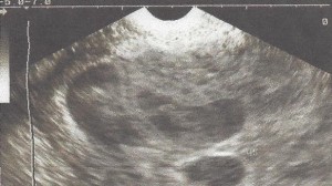 ultrasound